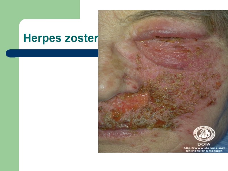 Herpes zoster